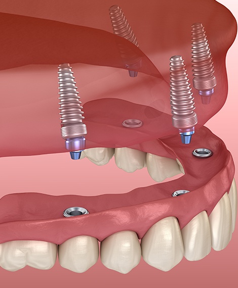 Animated full denture being placed over four dental implants