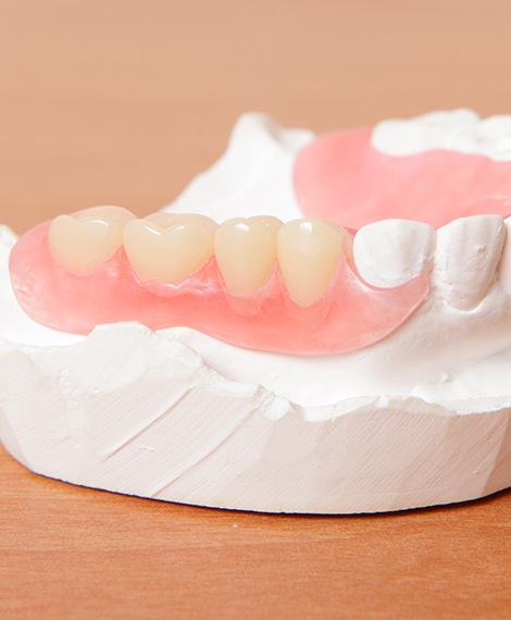 Model of the mouth with a partial denture replacing a few teeth