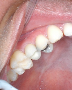 Closuep of smile with replacement tooth attached to dental implant