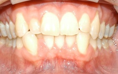 Closeup of smile before orthodontics