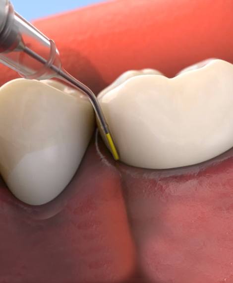 Close up of animated dental instrument placing topical antibiotic on gums