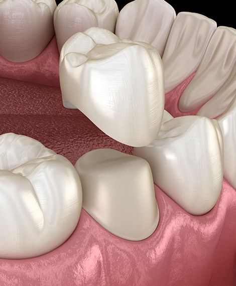 Animated porcelain dental crown being placed over a tooth