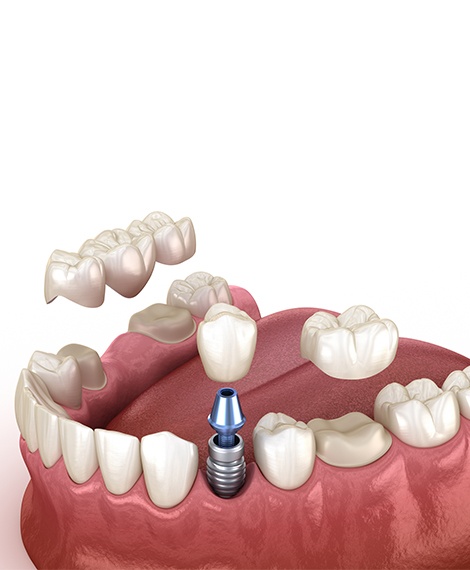 Animated smile receiving a dental crown a dental bridge and a dental implant