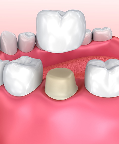 Animated porcelain dental crown being placed onto a tooth