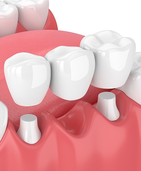 Animated row of teeth during dental bridge placement