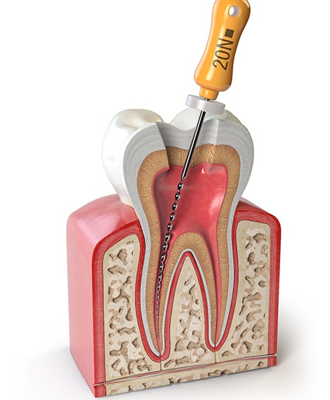 Illustration of root canal treatment in Henderson, NV