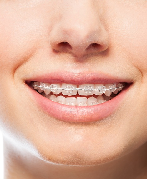 Close up of teeth with Six Month Smiles braces in place