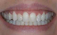 Flawless smile after Six Month Smiles orthodontics