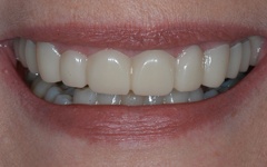Perfect smile after dental snap on case