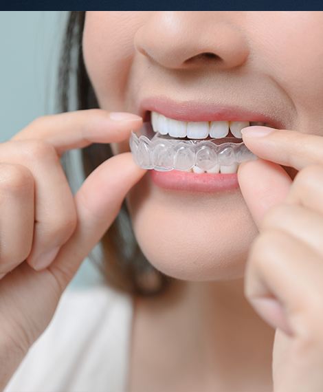 Close up of person placing their Sure Smile aligner tray over their teeth