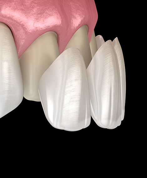 Animated dental veneer being placed over the front of a tooth