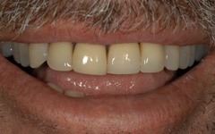 Discolored and damaged teeth before veneers
