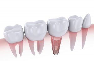 illustration of dental implant