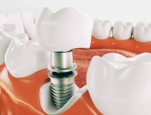 dental implant