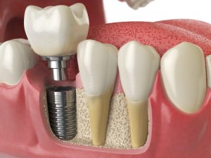 3D model of an implant in the lower jaw