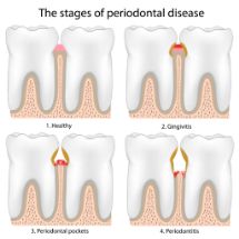 An illustration showing the stages of gum disease