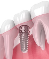 Render of dental implant in Henderson, NV in lower arch
