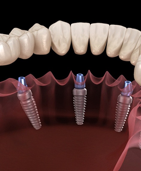 Animated model of All On 4 dental implants in Henderson