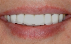 Closeup of brilliant smile after teeth whitening