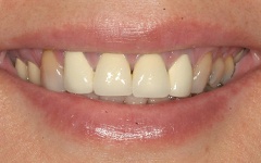 Closeup of yellow smile before teeth whitening