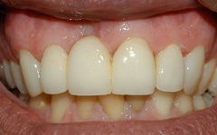 Closeup of smile after cosmetic dentistry