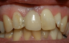 Closeup of smile before cosmetic dentistry