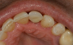 Closeup of smile after dental implant tooth replacement