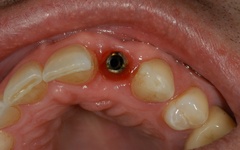 Closeup of smile with dental implant post visible