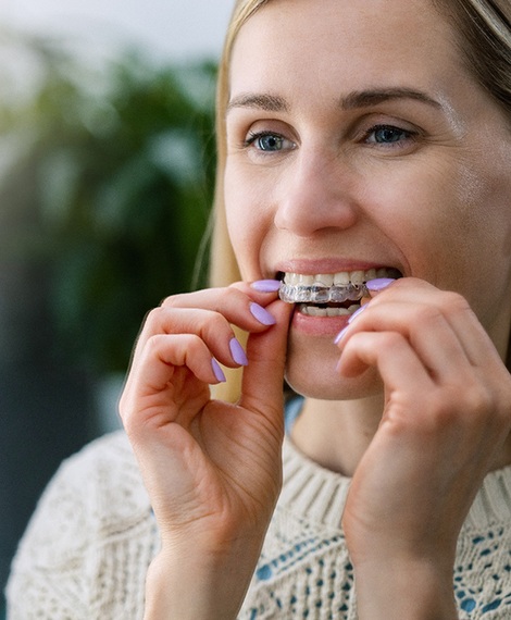 A young woman placing clear aligners over her teeth 