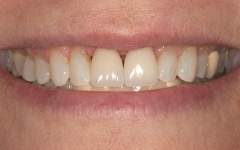 Closeup of flawless smile after dental crown restoration