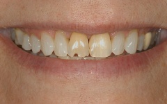 Closeup of smile with broken tooth before dental crown restoration