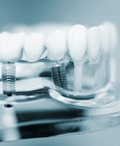 a model of a dental implant bridge