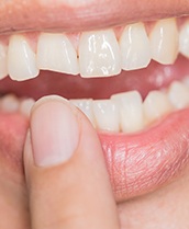 Closeup of smile with chipped front tooth