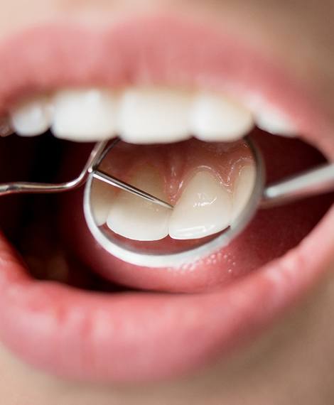 Closeup of teeth reflected in dental mirror