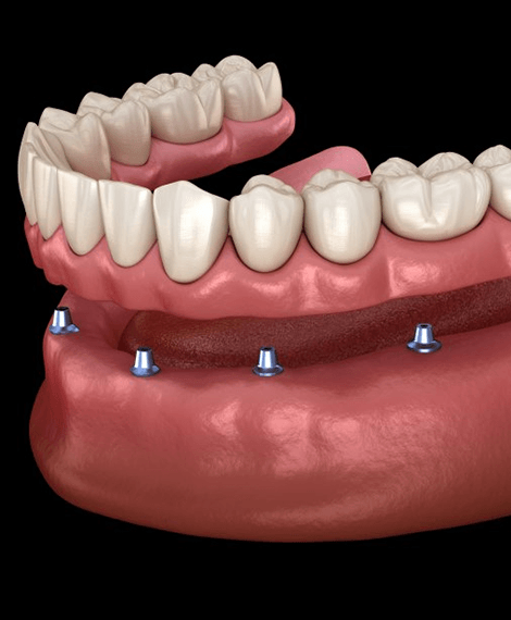 A digital example of an implant denture in Henderson