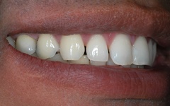 Closeup of smile after dental implant tooth replacement