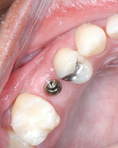 Closeup of smile with dental implant post visible