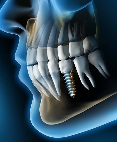 X-ray of a patient with dental implants in Henderson