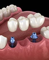 Two dental implants supporting a dental bridge