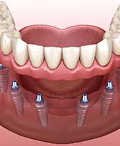 Six dental implants supporting a full denture