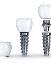 The three parts of a dental implant