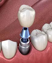 Single dental implant supporting a crown