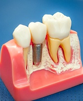 a model of a single dental implant