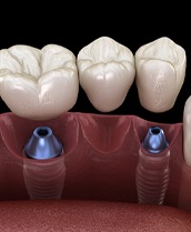 a computer illustration of an implant bridge