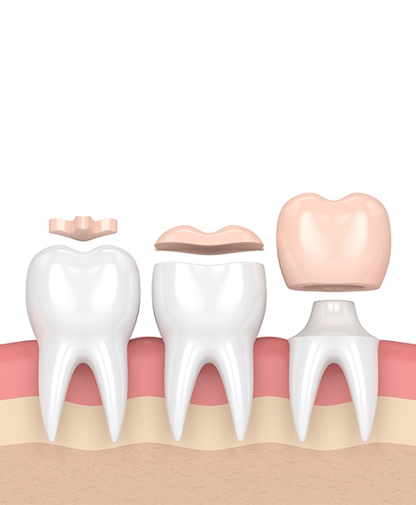Three animated teeth showing the difference between inlays onlays and dental crowns