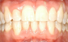 Closeup of aligned smile after orthodontics