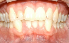 Closeup of smile before orthodontics