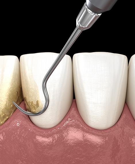 Animated dental instrument removing plaque from teeth during gum disease treatment