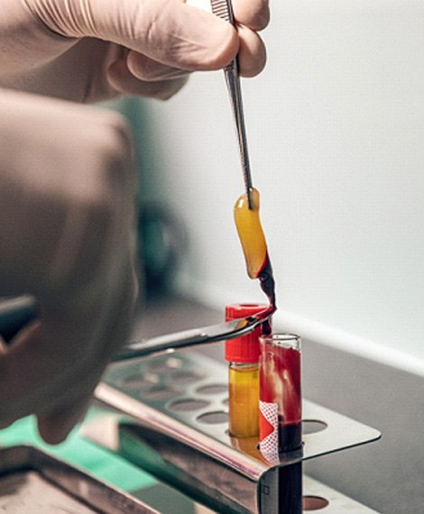 PRF content coming out of a vial of blood that was in a centrifuge