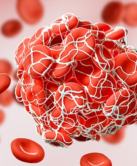 diagram of a blood clot forming in PRF